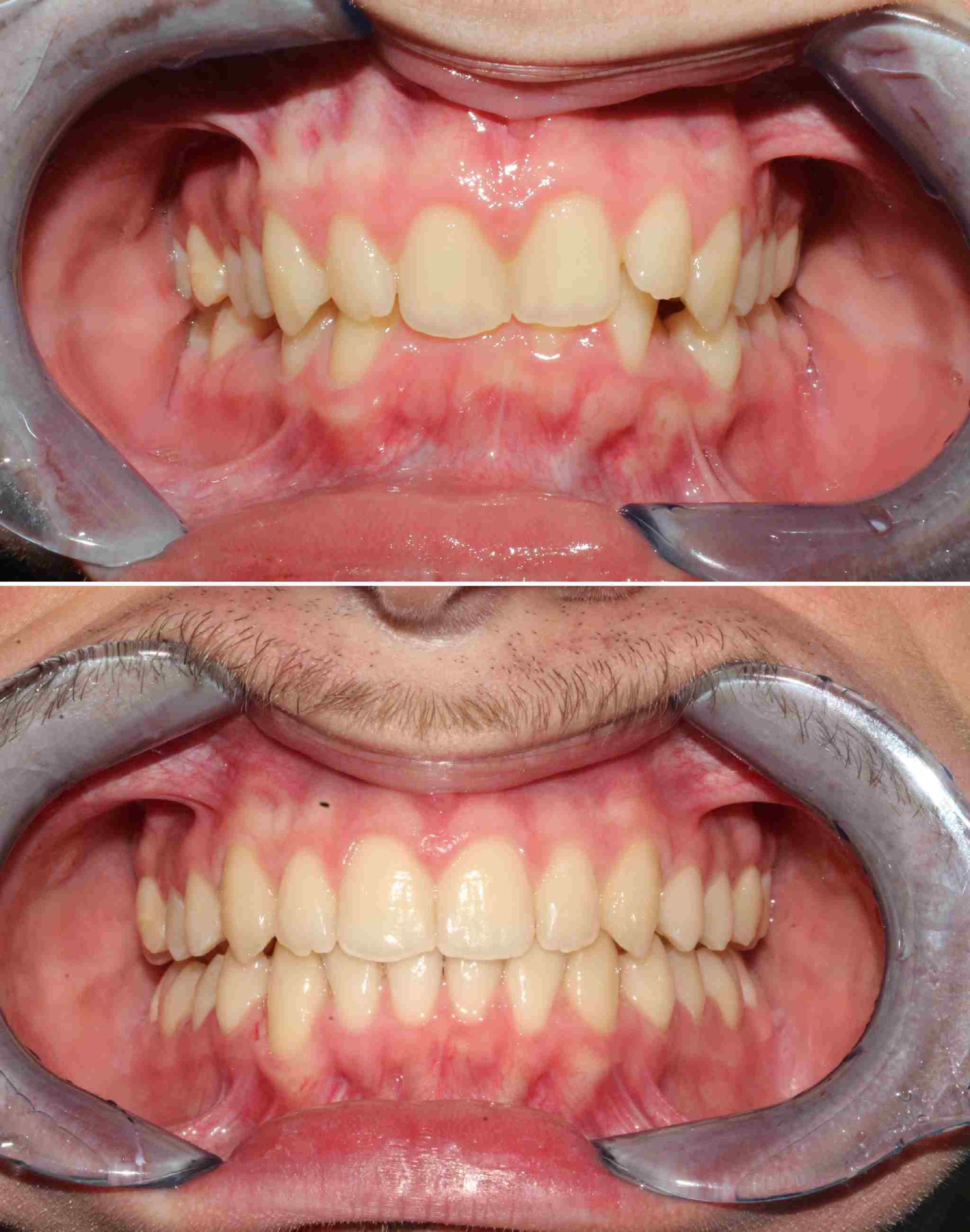 Allineamento denti - Somma Lombardo (VA)