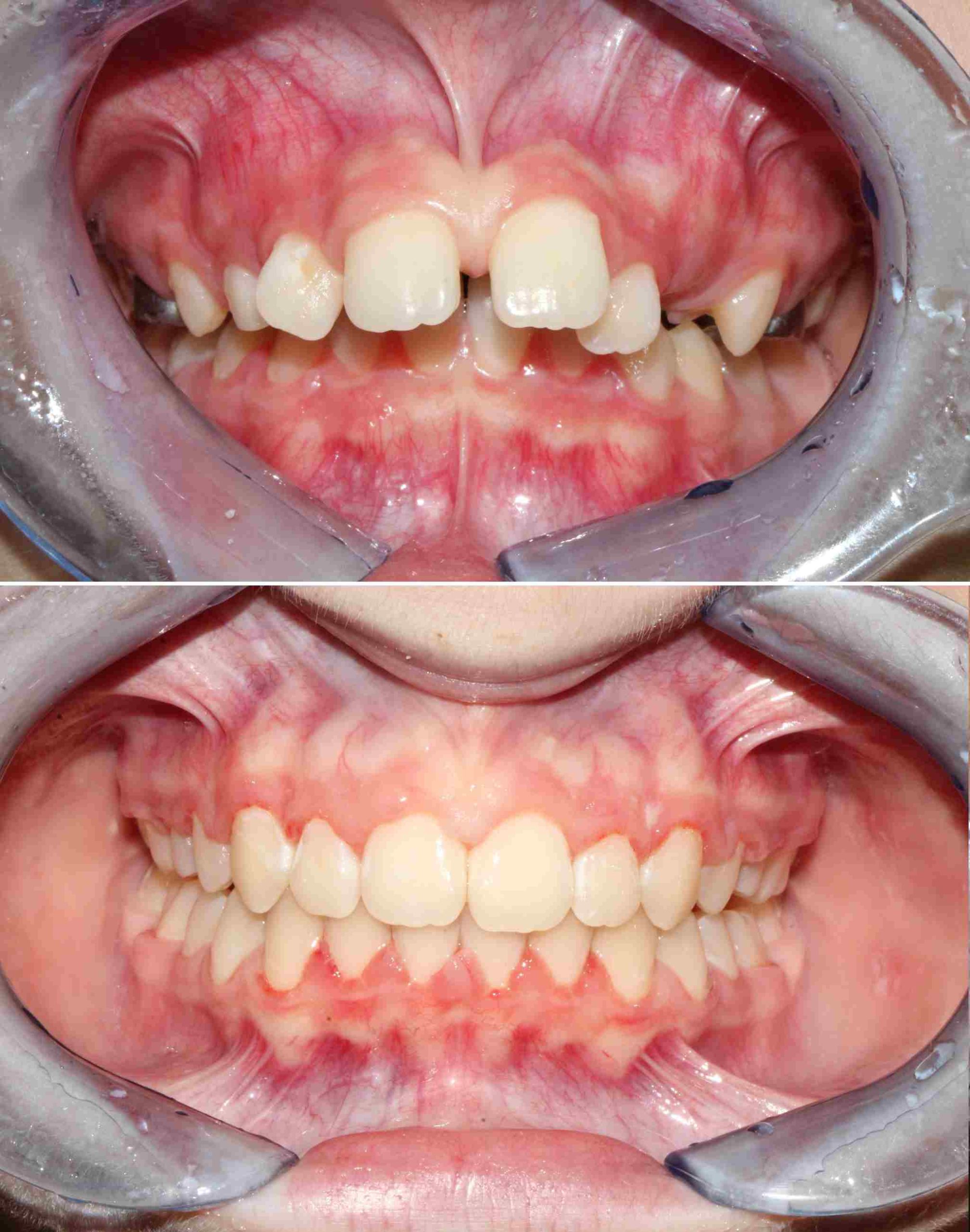 Allineamento denti - Somma Lombardo (VA)