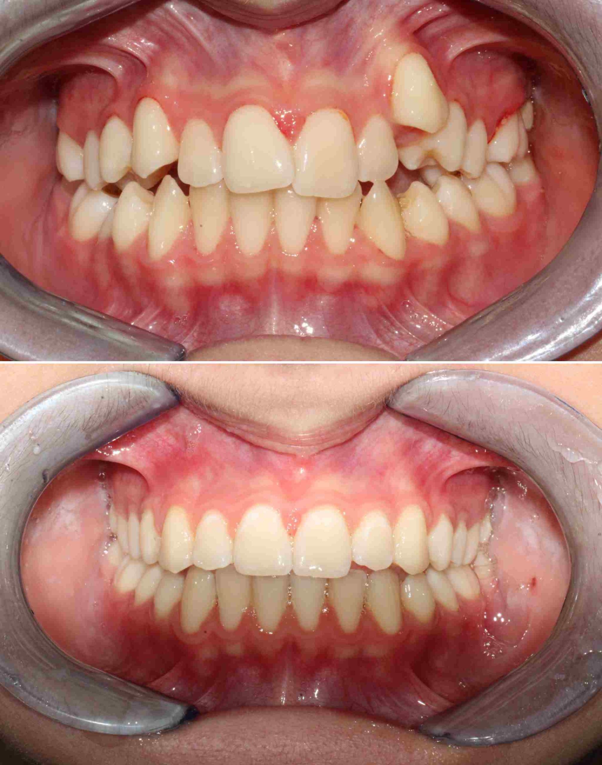 Allineamento denti - Somma Lombardo (VA)