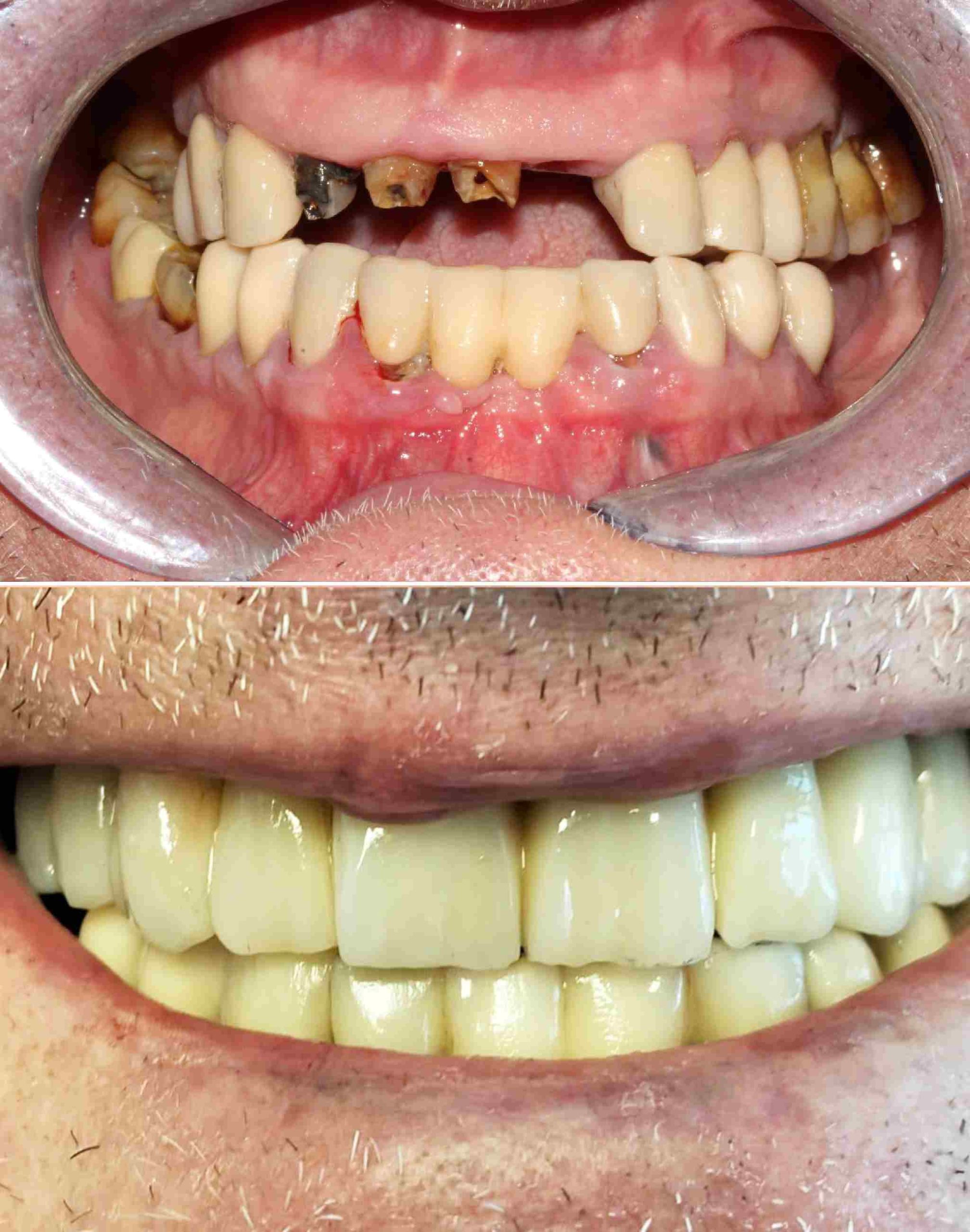 Impianti dentali Somma Lombardo