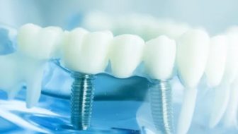 Protesi dentali mobili o fisse Somma Lombardo