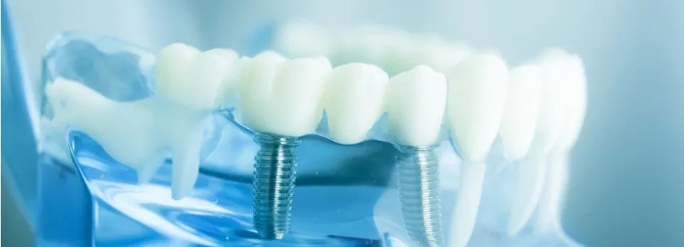 Protesi dentali mobili o fisse Somma Lombardo