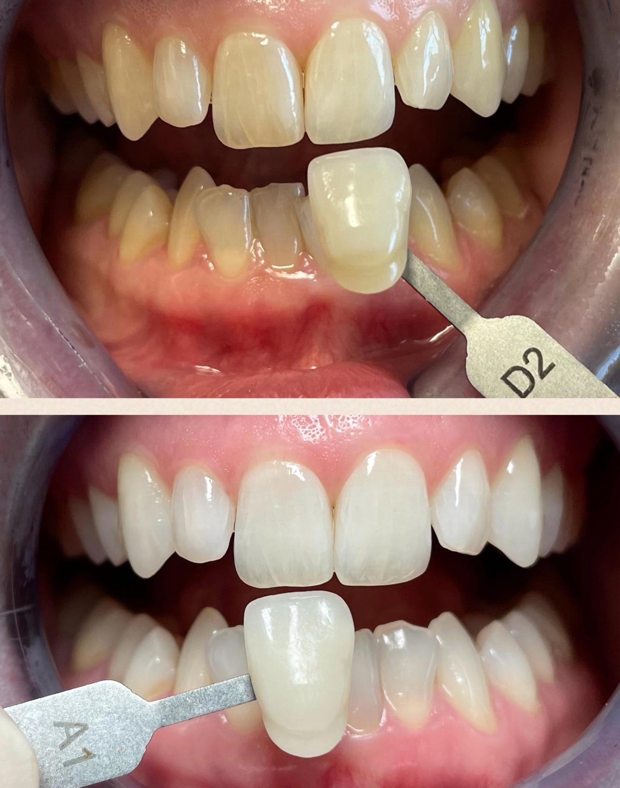 Sbiancamento dentale a Somma Lombardo (VA)